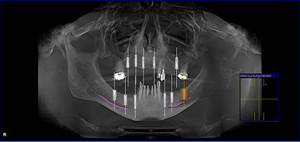 3D- Volumentomographie